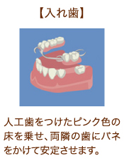 【入れ歯】人工歯をつけたピンク色の床を乗せ、両隣の歯にバネをかけて安定させます。